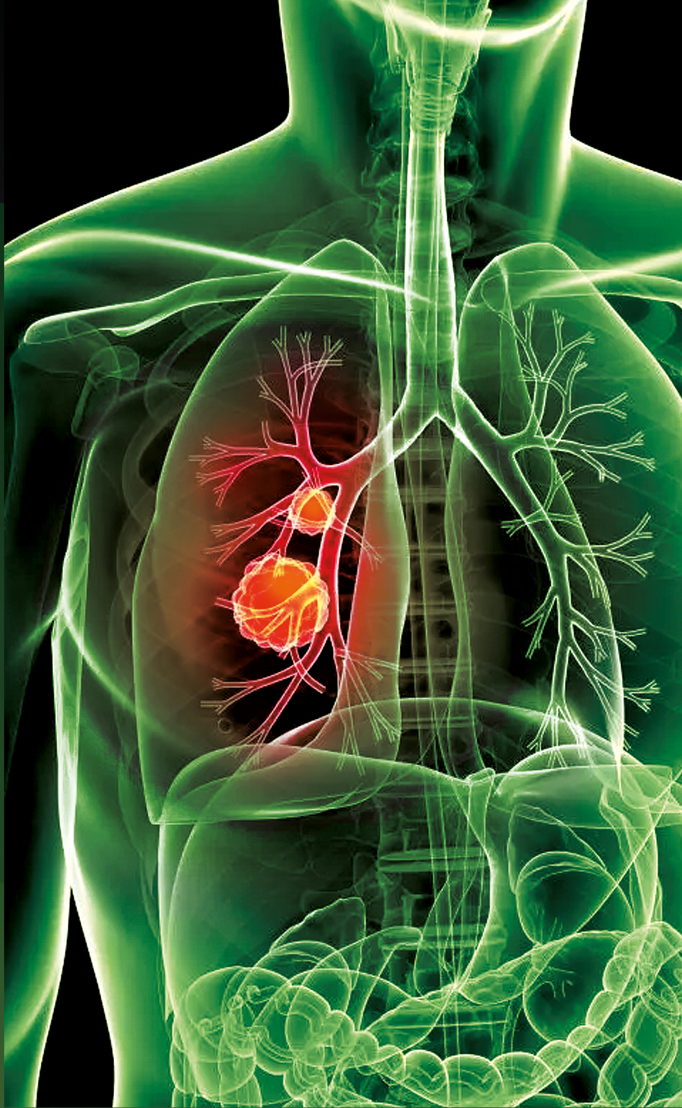 lung x-ray