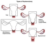 types of hysterectomy