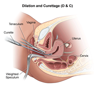 dilation