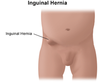 inguinal hernia