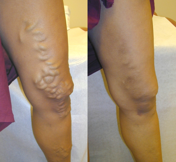 varicose veins before and after